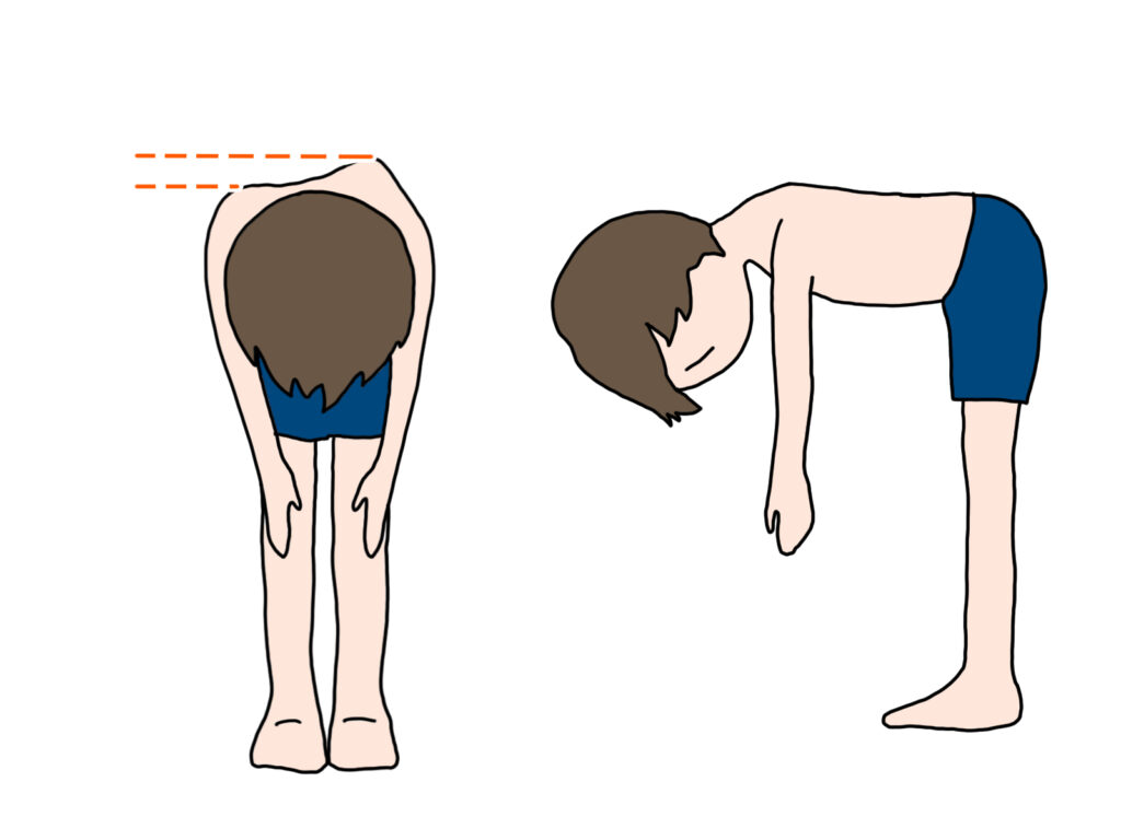 子どもの側弯症について：原因と整体でのアプローチ