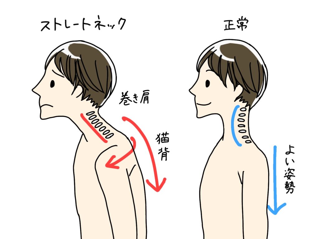 ストレートネックの原因と解決法　整体で始める健康生活