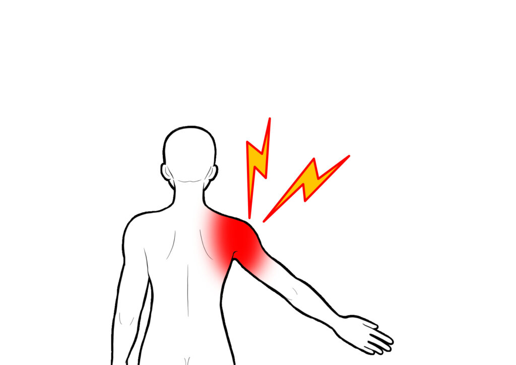 肩関節の石灰化（石灰沈着性腱板炎）後の過ごし方と注意点